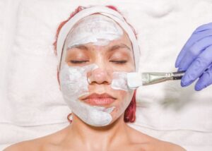chemical peel treatment