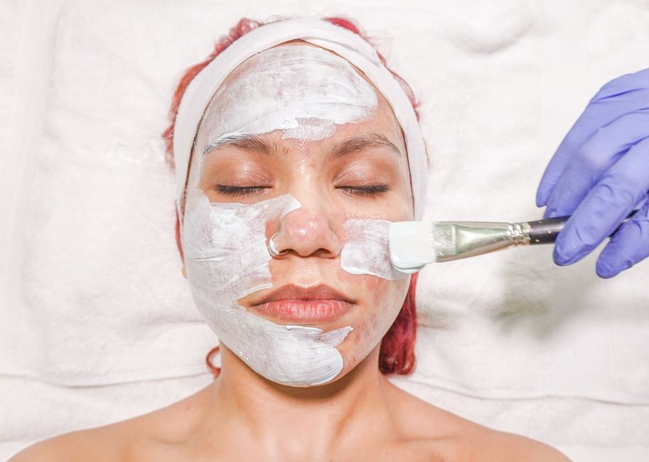 chemical peel treatment